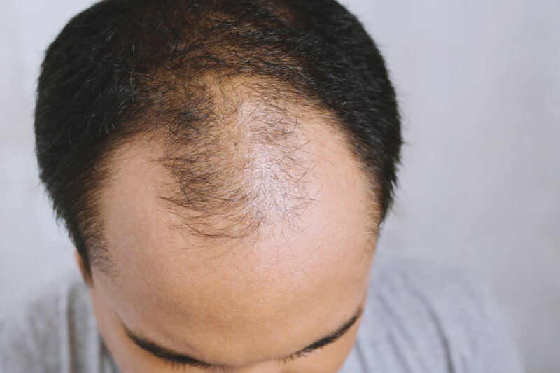 hairline jokes